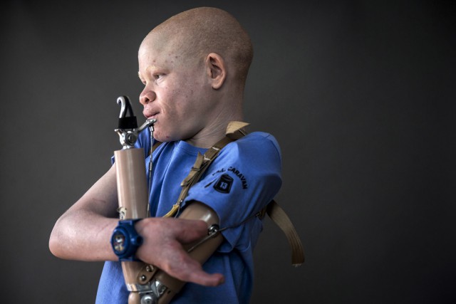 Охотники отрезают конечности детей-альбиносов в Танзании, чтобы сделать из них амулеты и чудодейственные эликсиры