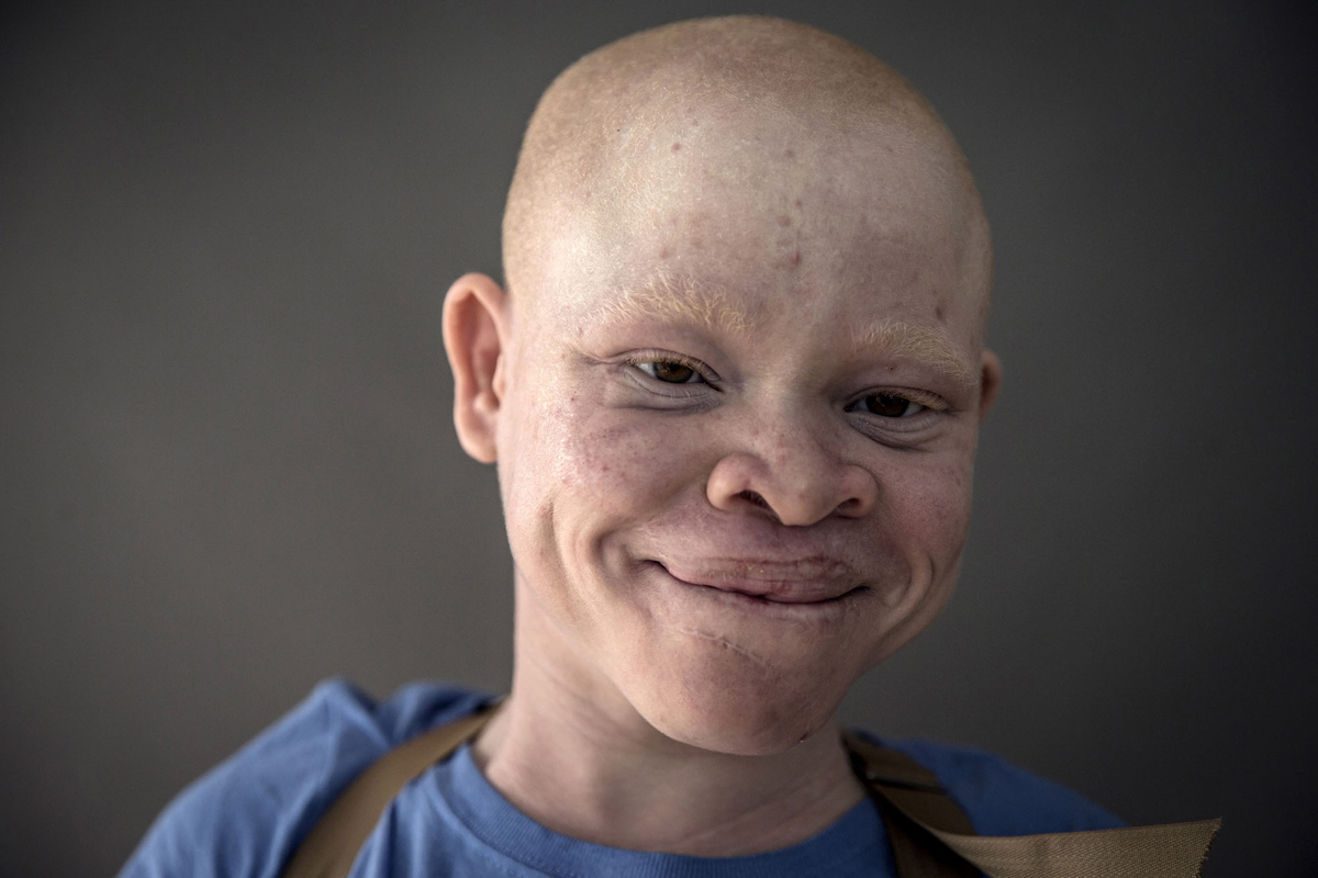 Deti albinosy Tanzanii foto 13