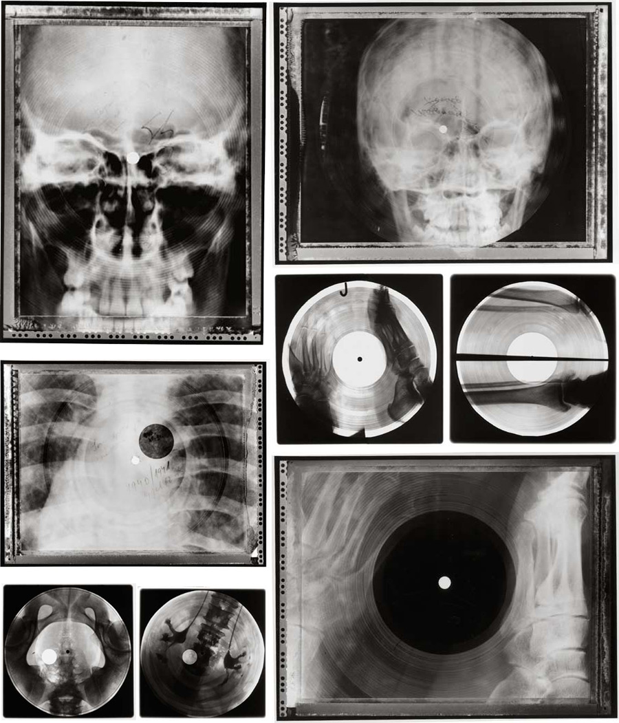 Музыка на костях: как в СССР запрещённую западную музыку подпольно записывали на рентгеновских снимках