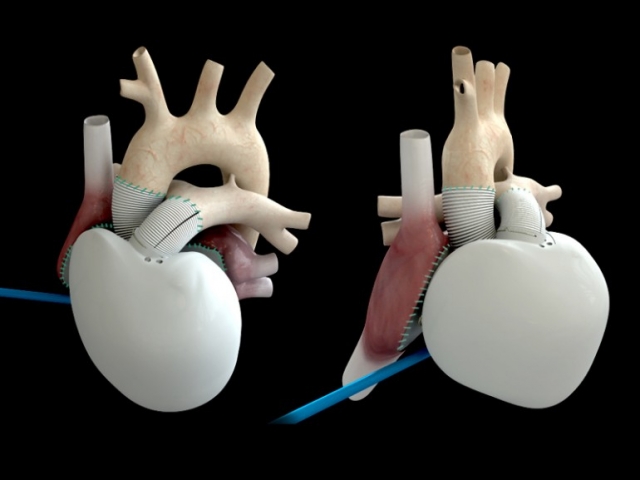 Саморегулируемое искусственное сердце CARMAT имплантировано в человека