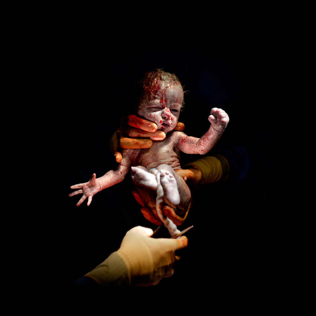 Первые секунды жизни младенцев после кесарева сечения - спорные фото