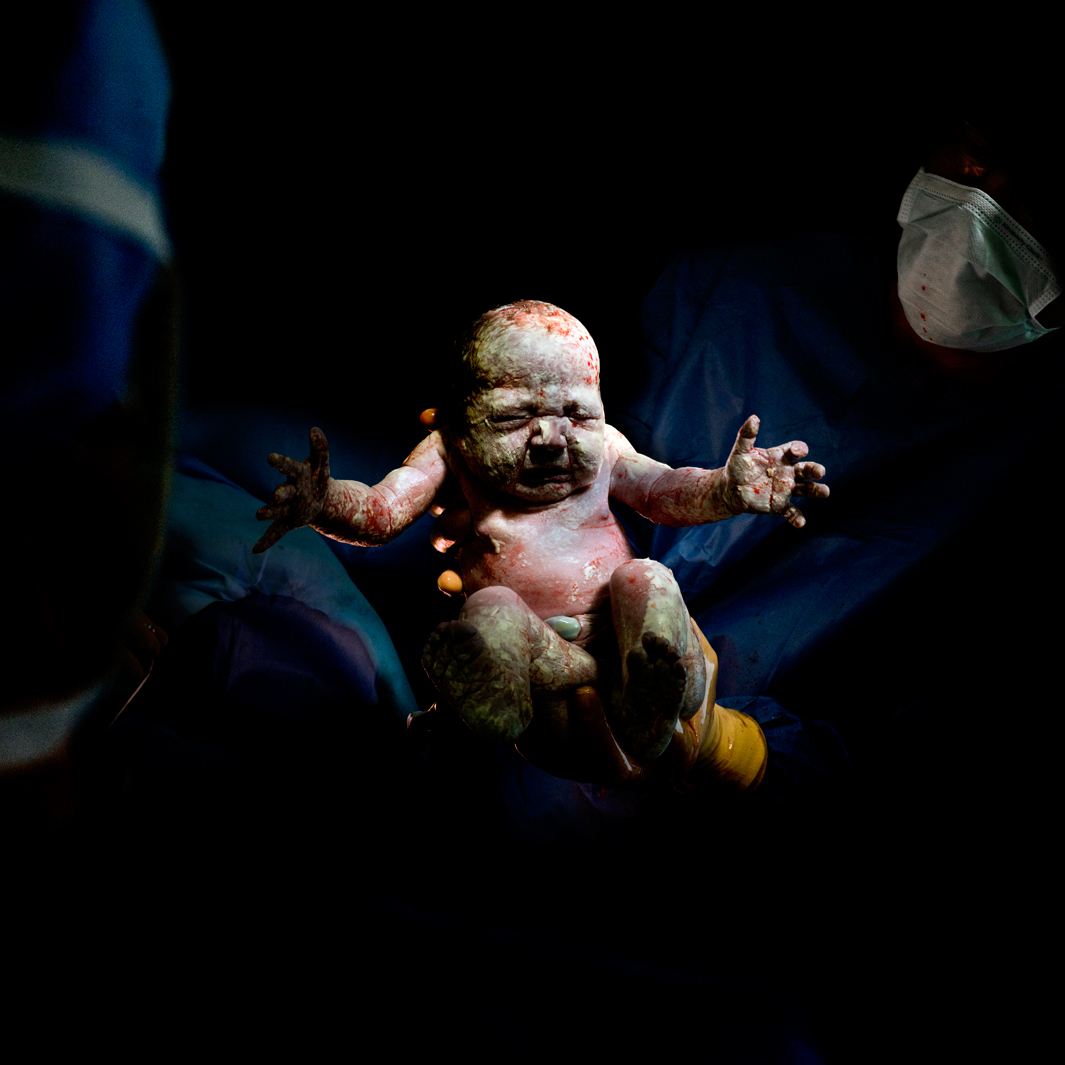Первые секунды жизни младенцев после кесарева сечения - спорные фото