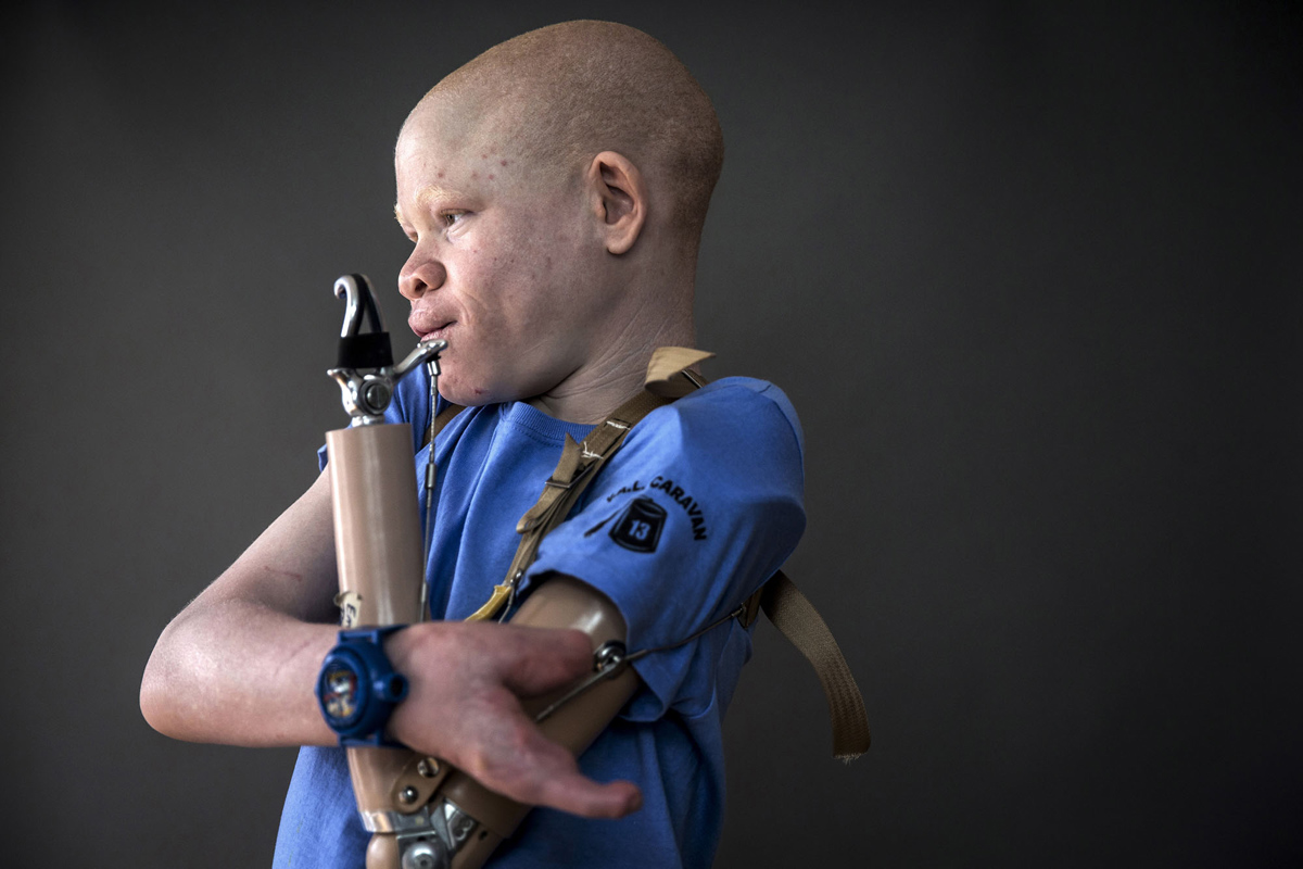 Deti albinosy Tanzanii foto 1