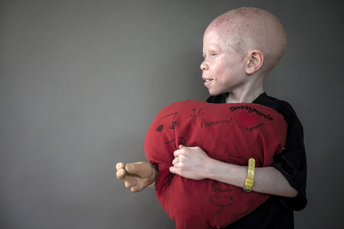 Deti albinosy Tanzanii foto 16