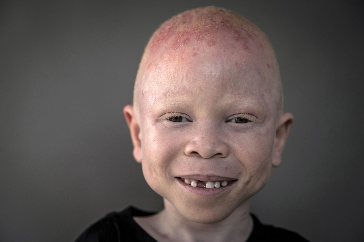 Deti albinosy Tanzanii foto 4