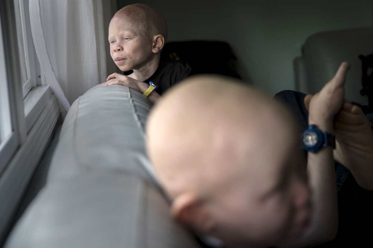 Deti albinosy Tanzanii foto 6