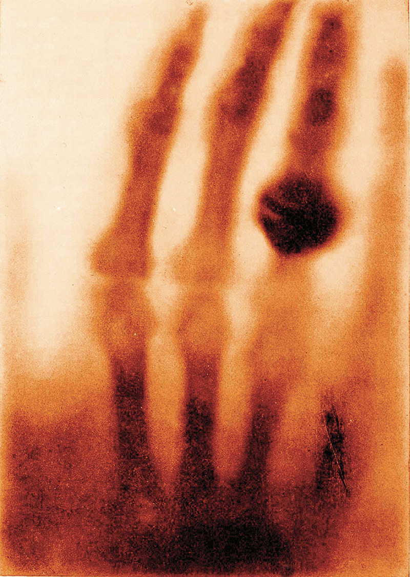 The Hand of Mrs. Wilhelm Röntgen Wilhelm Conrad Röntgen 1895