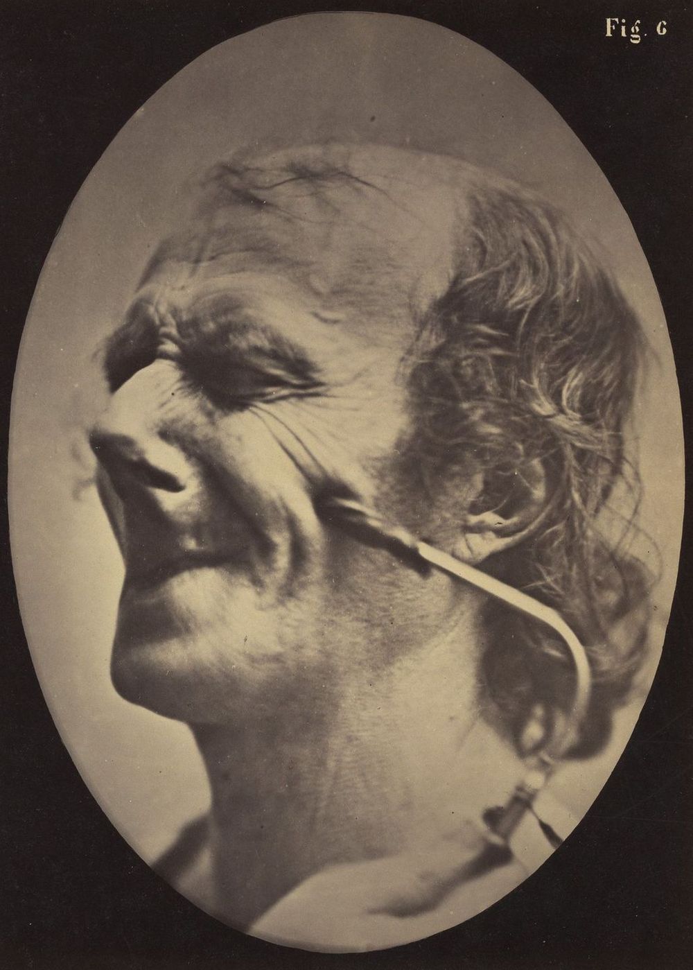 Зрелищные фотографии из книги невропатолога Дюшена де Булоня   8