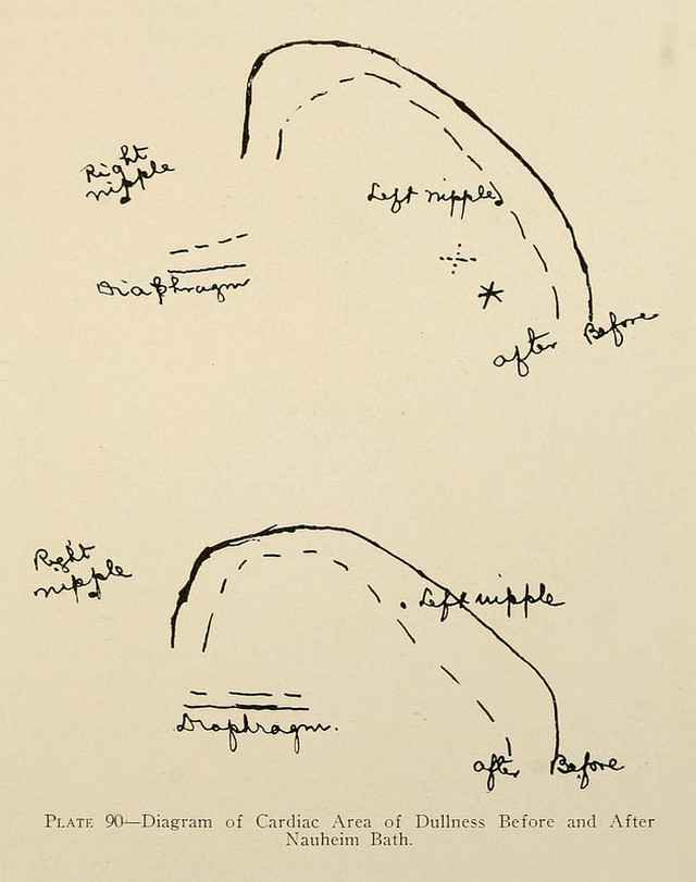Душ, пар и клизма от паранойи и алкоголизма: иллюстрации из «Практической гидротерапии» 1909 года 18